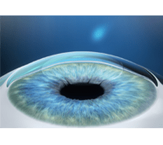 CORNEA-MAIS-ESFERICA