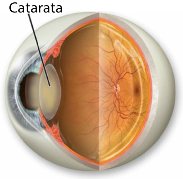 Catarata