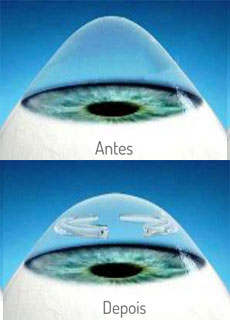 cornea