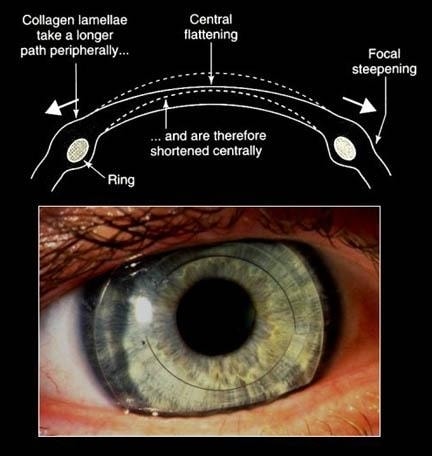 curvatura da cornea