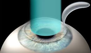 lasik
