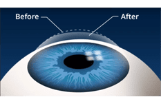 lasik