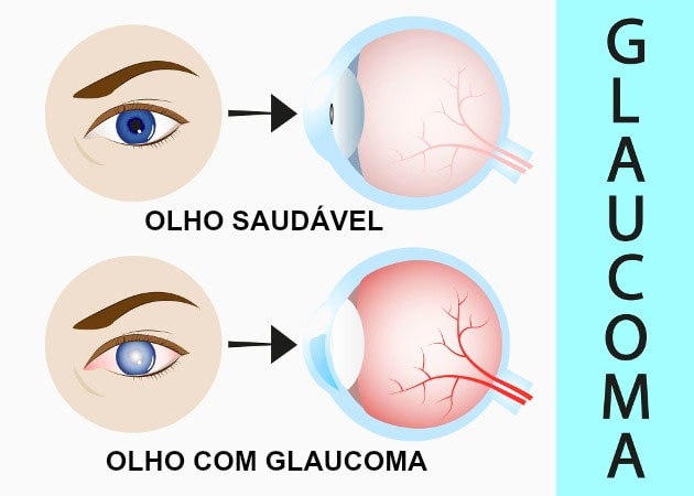 Glaucoma