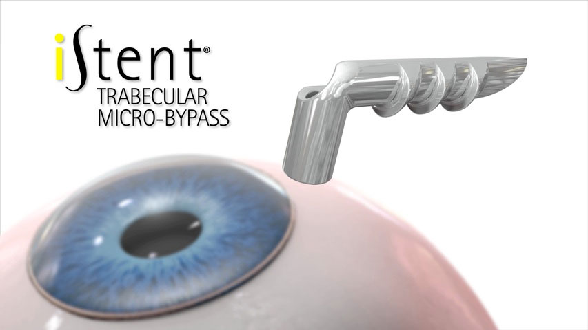 Glaucoma